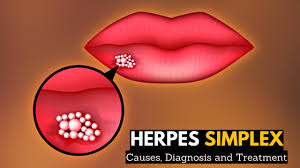 herpes simplex (2)