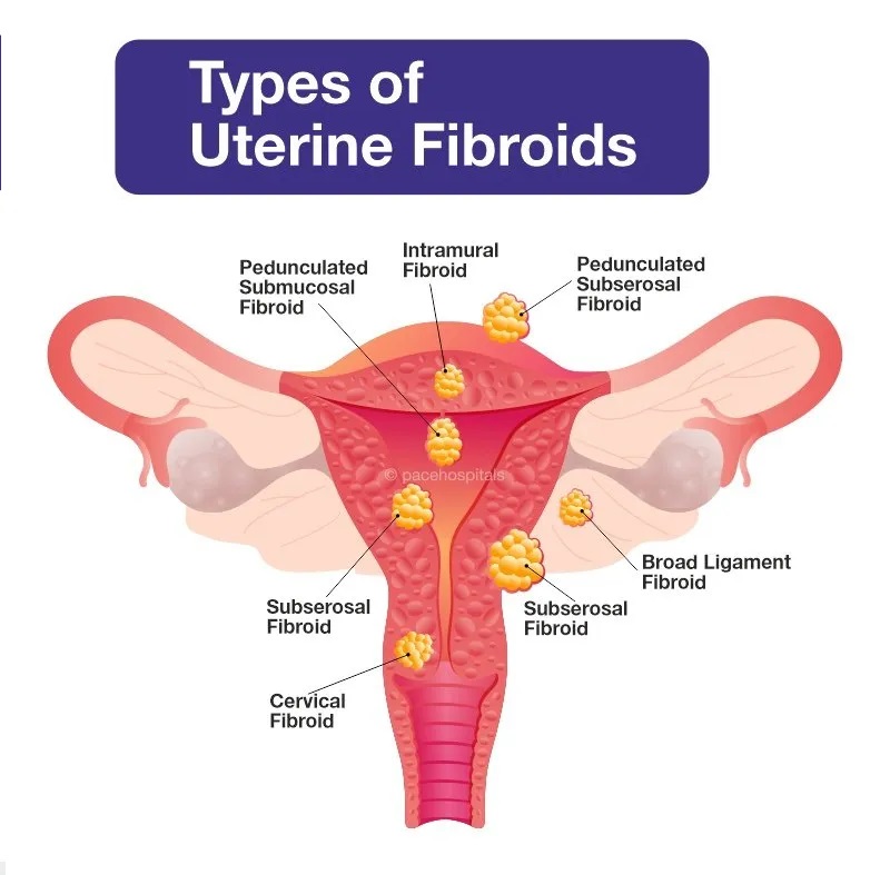 Uterine fibroids 2