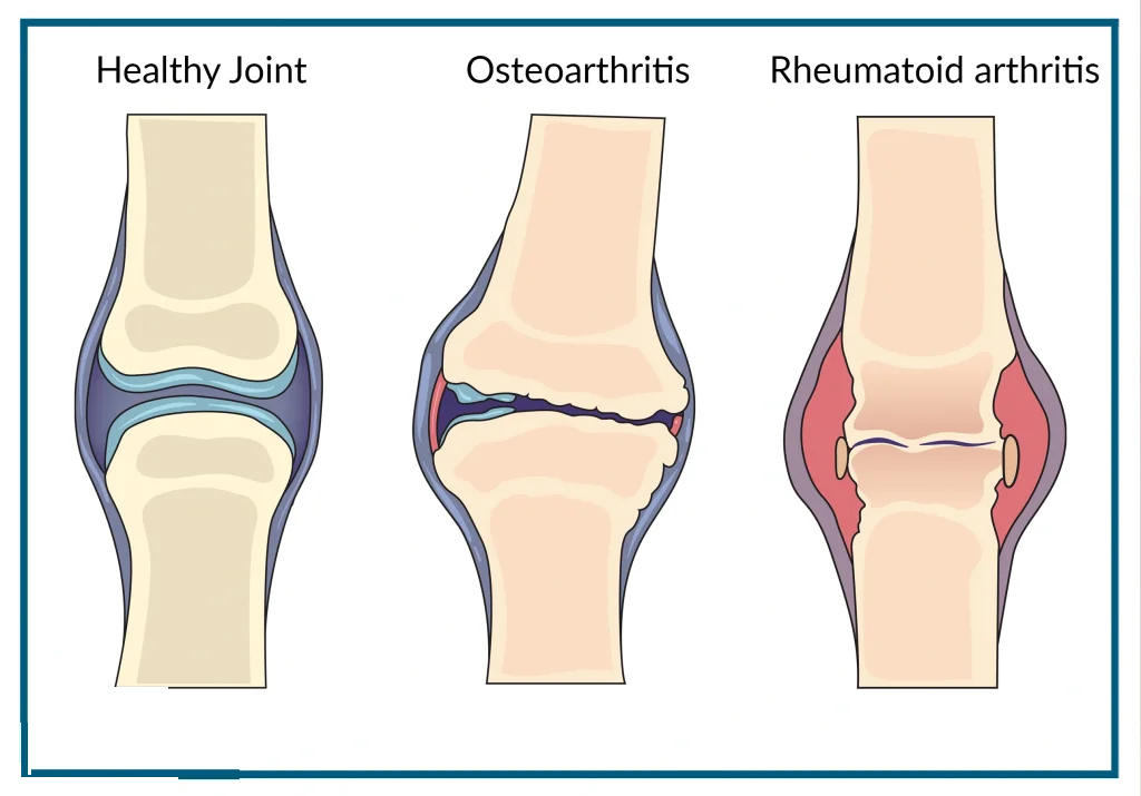 Medical diagram comparing a healthy knee joint with an osteoarthritis joint showing cartilage erosion and bone-on-bone friction.