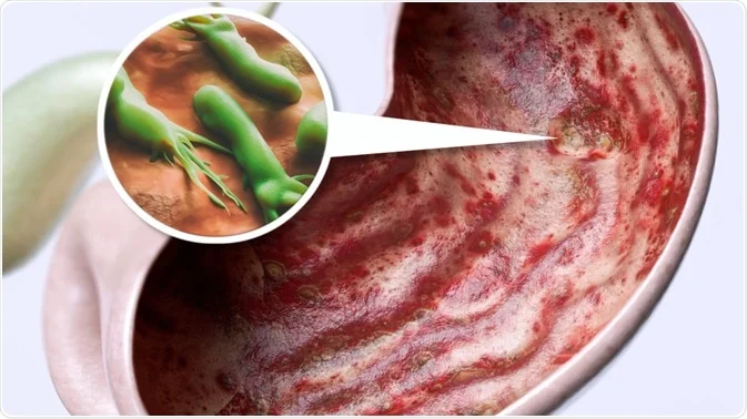best-treatment-of-h-pylori-in-kenya